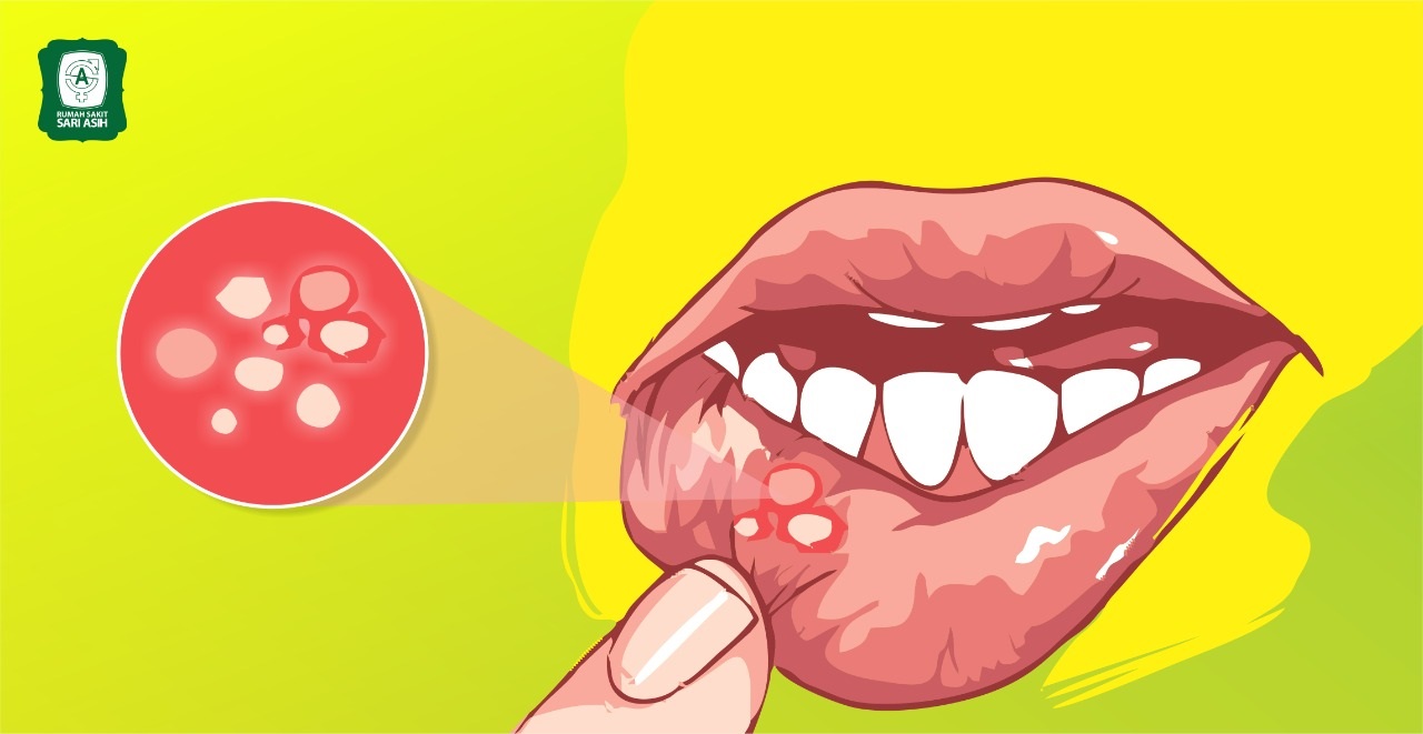 Penyebab sariawan di bibir