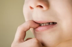 Penggunaan Kawat Gigi untuk Memperbaiki Fungsi Mengunyah Anak
