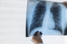 Meski Berbahaya, Tuberkulosis Bisa Disembuhkan
